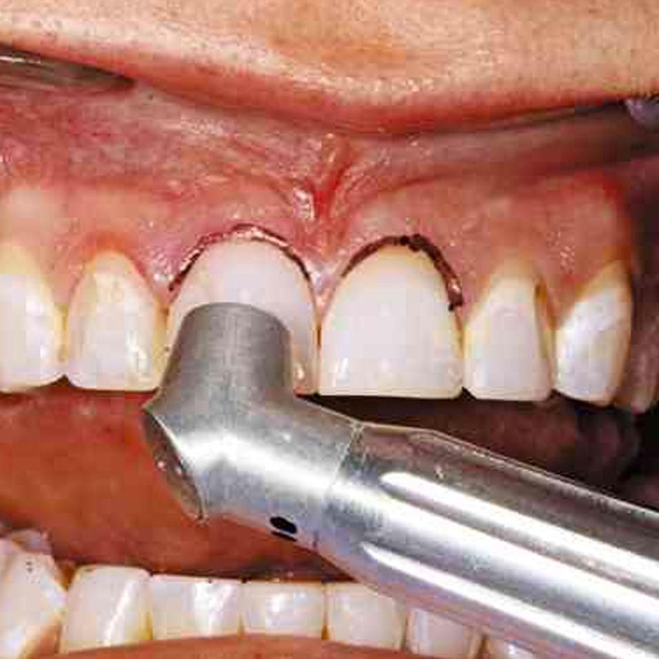 Solea-procedure